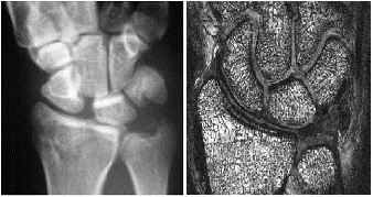 Radiograph of SL Dissociation (left); High Resolution MR Image of the Radiocarpal Joint (right)