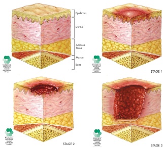 "Different stages of pressure sores as defined by the NPUAP (www.npuap.org)"