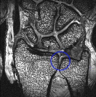 "The blue circle encloses part of the Distal Radioulnar Joint"