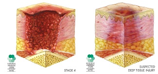 "Different stages of pressure sores as defined by the NPUAP (www.npuap.org)"