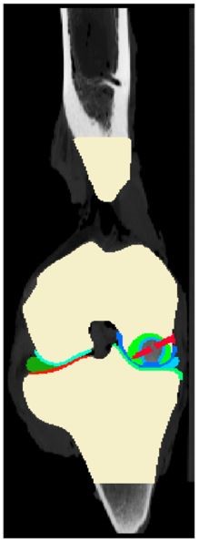 Segmented CT Image with Lag Screw (in red)