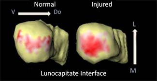 Comparison between a normal and an injured lunocapitate