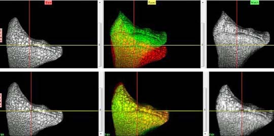 "Radius registration as seen in Analyze 5.0 (Mayo Clinic, MN)"