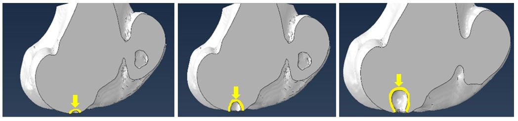 Fig 4: From left to right: 0.03 cm3, 0.5 cm3, and 2 cm cysts3