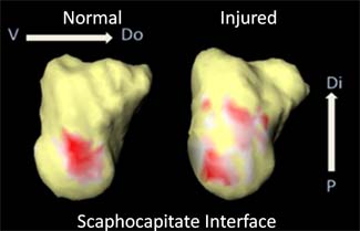 Comparison between a normal and an injured scaphocapitae