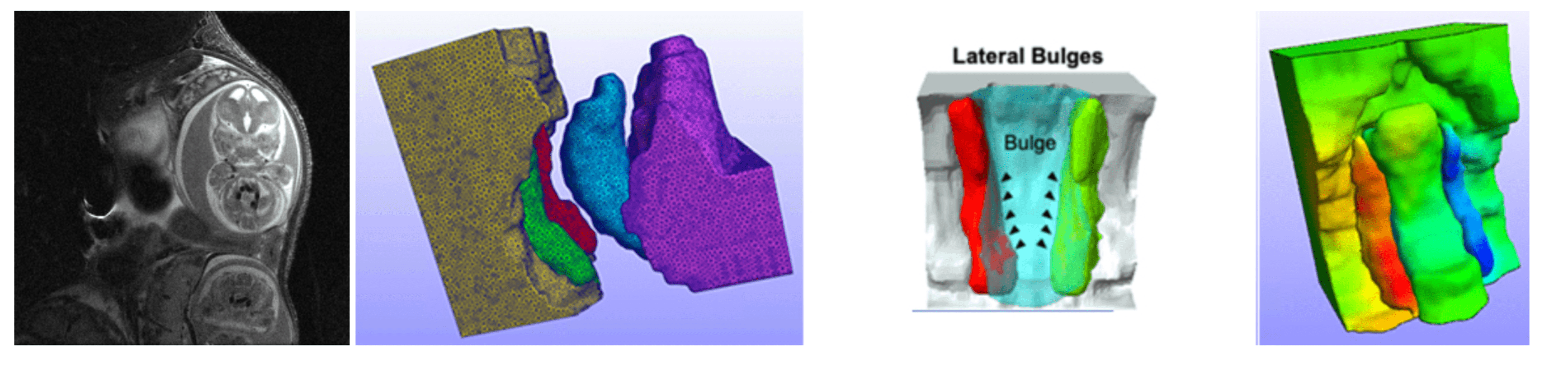 "MRI-Based Modeling of Palatal Shelf Elevation"