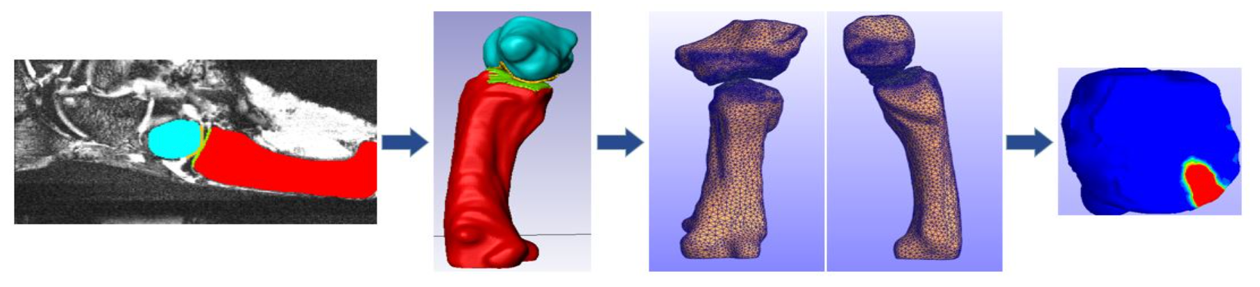 "MRI-Based Basilar Thumb Joint Modeling"