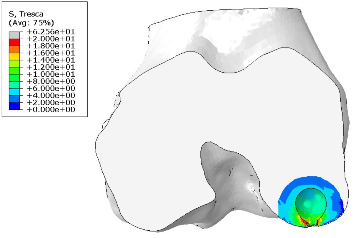 Fig 3: Shear stresses (in MPa) in a region of interest surrounding a 1 cm3 cyst