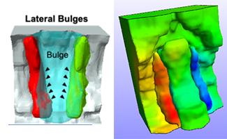 Lateral buldges from MRI and predicted displacements correspond